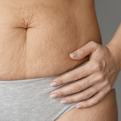 Stretch Marks