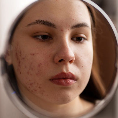 Active Acne Treatment: Face