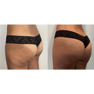 Muscle Sculpting: Buttock, Brazilian Butt Lift