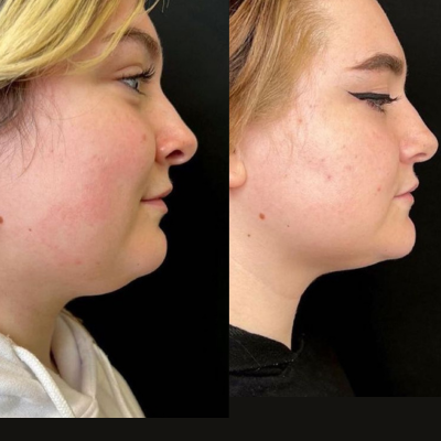 Double Chin Removal