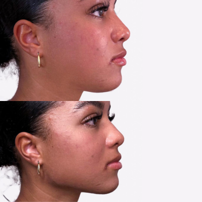 Jawline Contouring: 1 Syringe Juvederm