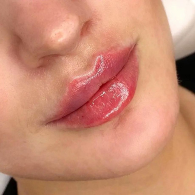 Lip Augmentation: 1 Syringe Restylane