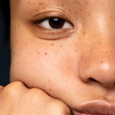 Pigmentation Removal: Face