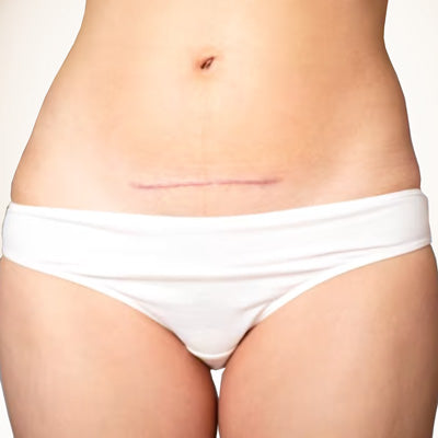 Scar Removal: Small Area (less than 3 inch)