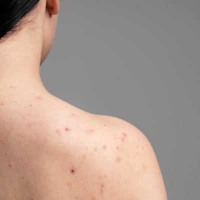 Active Acne Treatment: Body